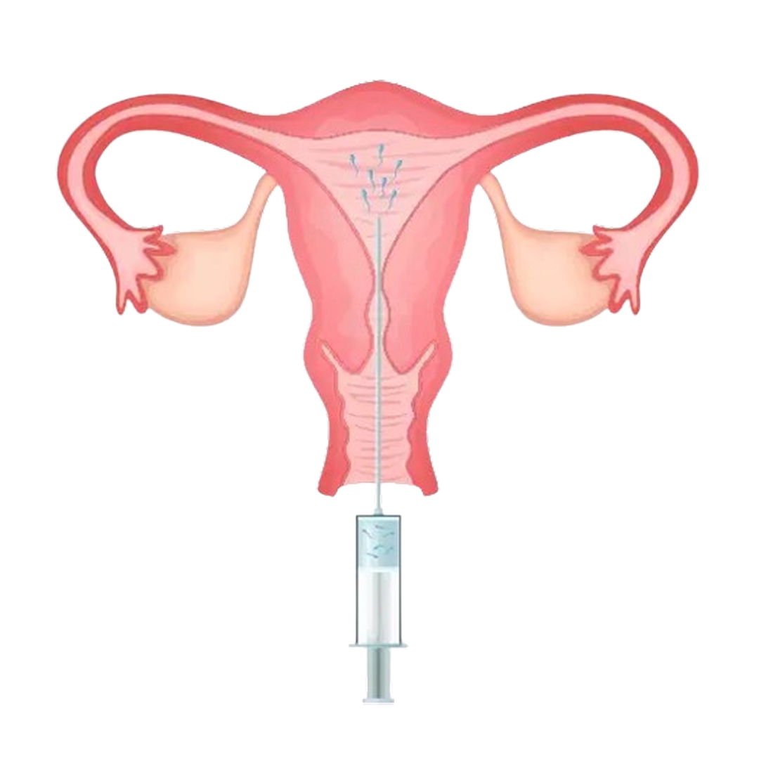 IUI (Intrauterine Insemination) klinik ayra serdang