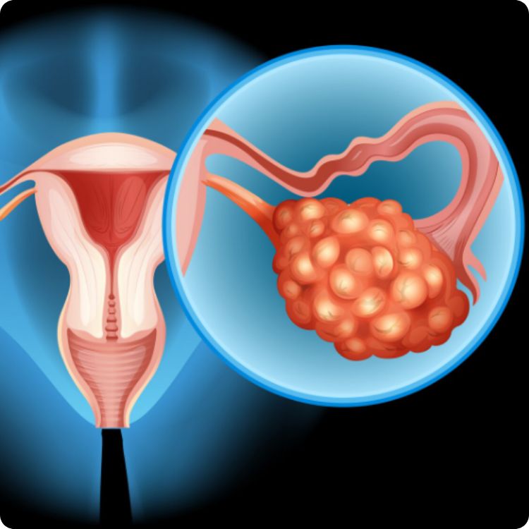 pcos bukan masalah biasa. ada kesan jangka panjang