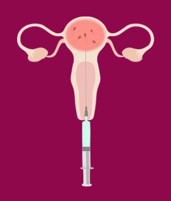 IUI